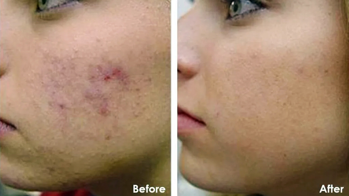 CHEMICAL PEELING TREATMENT